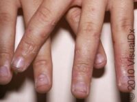 Dyshidrotic Eczema
