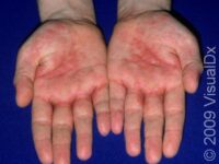 Dyshidrotic Eczema