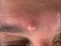 Epidermoid Cyst