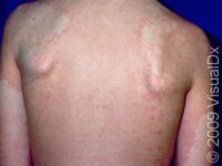 Fifth Disease (Erythema Infectiosum)
