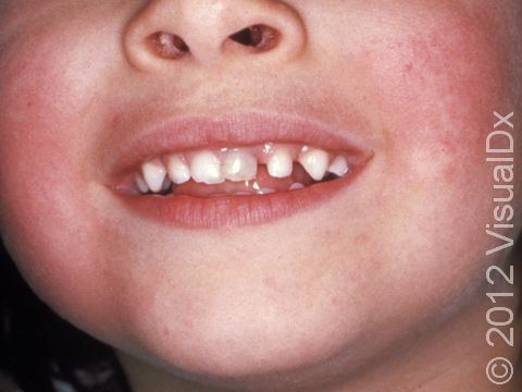 This image displays the appearance of red cheeks typical in fifth disease.