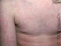 Fifth Disease (Erythema Infectiosum)