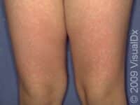Fifth Disease (Erythema Infectiosum)