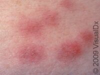 Erythema Nodosum
