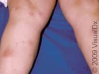 Erythema Nodosum – Adult