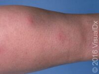 Erythema Nodosum