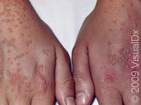 This image displays multiple flat warts.