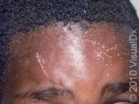 Flat Wart