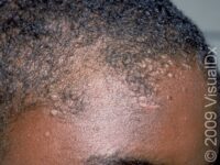 Flat Wart