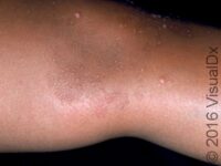Flat Wart