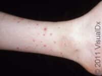 Flea Bite