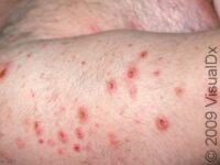 Folliculitis