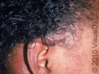 Folliculitis