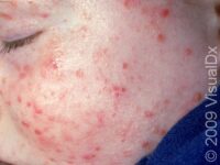 Folliculitis