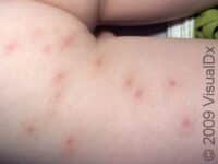 Folliculitis
