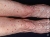 Folliculitis