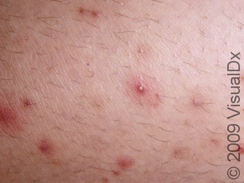 Folliculitis is an inflammation of the hair follicles.