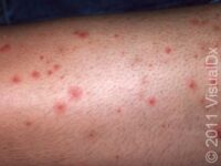 Folliculitis