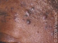Folliculitis