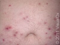 Folliculitis
