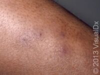 Folliculitis