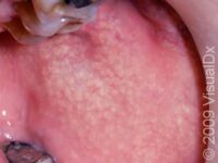 Fordyce Spots