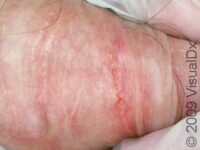 Fordyce Spots