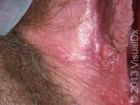 Genital Herpes
