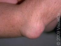 Gout – Adult