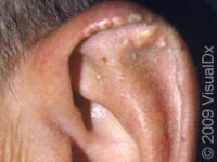 Gout