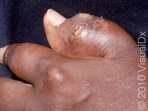 This image display a frequent location of gout, the fingers.