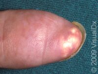 Gout