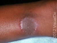 Granuloma Annulare
