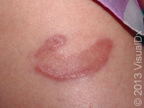 The typical lesions of granuloma annulare are ring-like, brownish-red, and slightly elevated lesions.