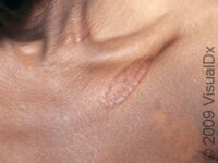 Granuloma Annulare