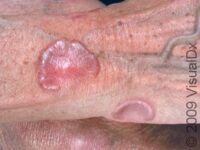 Granuloma Annulare