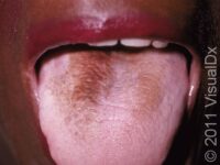 Hairy Tongue – Adult