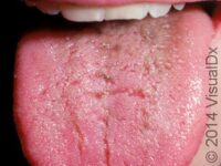 Hairy Tongue