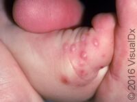 Hand-Foot-and-Mouth Disease