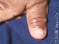 Hand-Foot-and-Mouth Disease