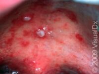 Hand-Foot-and-Mouth Disease