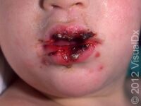 Herpes Simplex Virus (HSV)