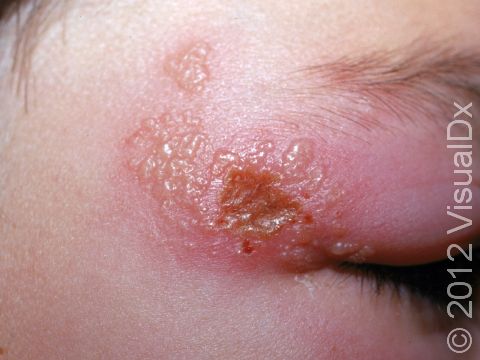 Though more common near the lips, grouped blisters (vesicles) can occur anywhere in herpes infections.