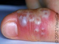 Herpes Simplex Virus (HSV)