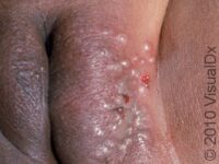 Herpes Simplex Virus (HSV)