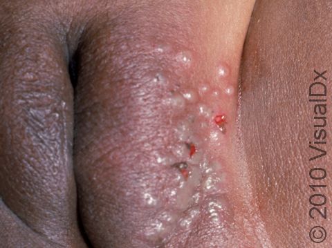 This image displays a 2 year old with primary herpes simplex involving the genital area.