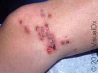 Herpes Simplex Virus (HSV)