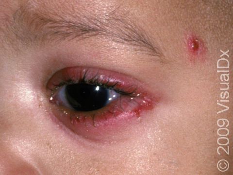 The herpes simplex virus can involve the eyelids and the cornea.