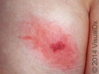 Herpes Simplex Virus (HSV)