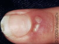 Herpetic Whitlow